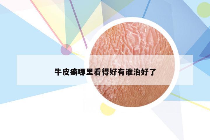 牛皮癣哪里看得好有谁治好了