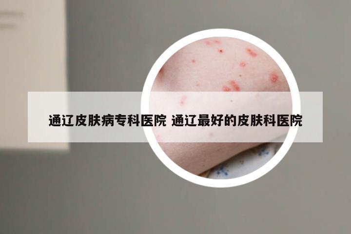 通辽皮肤病专科医院 通辽最好的皮肤科医院
