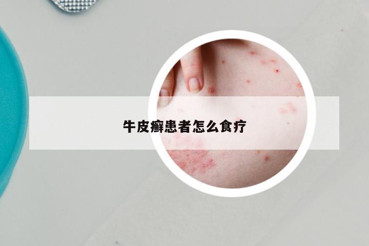 牛皮癣患者怎么食疗