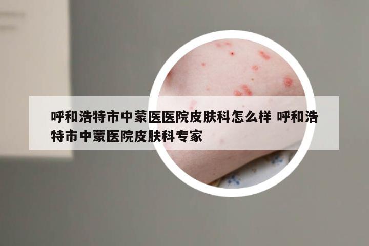 呼和浩特市中蒙医医院皮肤科怎么样 呼和浩特市中蒙医院皮肤科专家