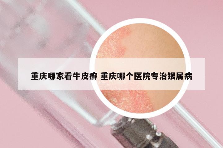 重庆哪家看牛皮癣 重庆哪个医院专治银屑病