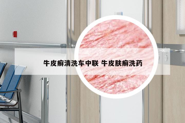 牛皮癣清洗车中联 牛皮肤癣洗药