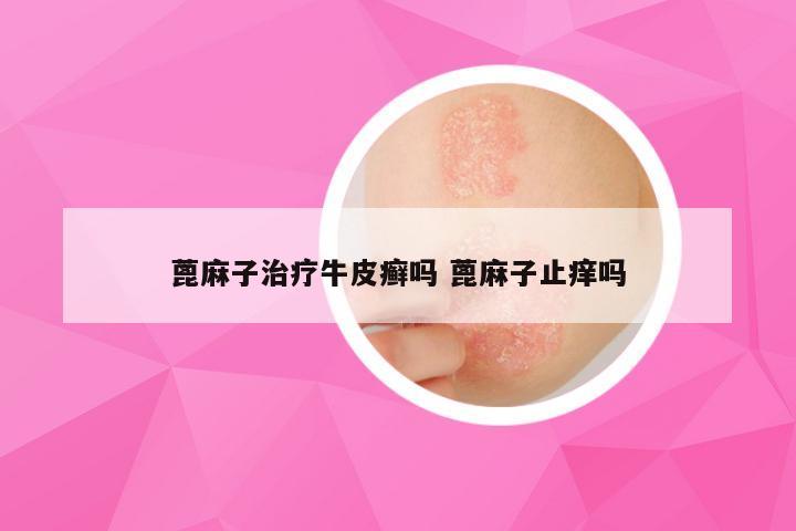 蓖麻子治疗牛皮癣吗 蓖麻子止痒吗