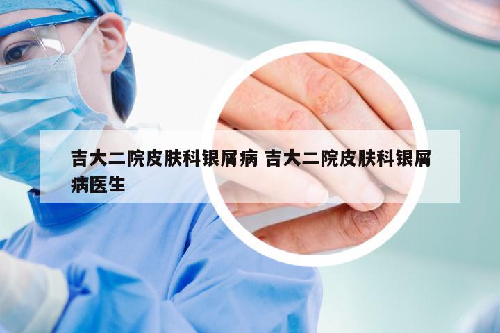 吉大二院皮肤科银屑病 吉大二院皮肤科银屑病医生