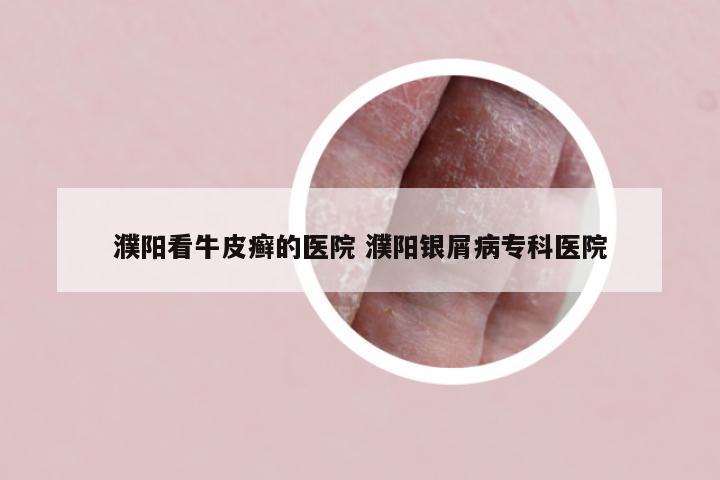 濮阳看牛皮癣的医院 濮阳银屑病专科医院