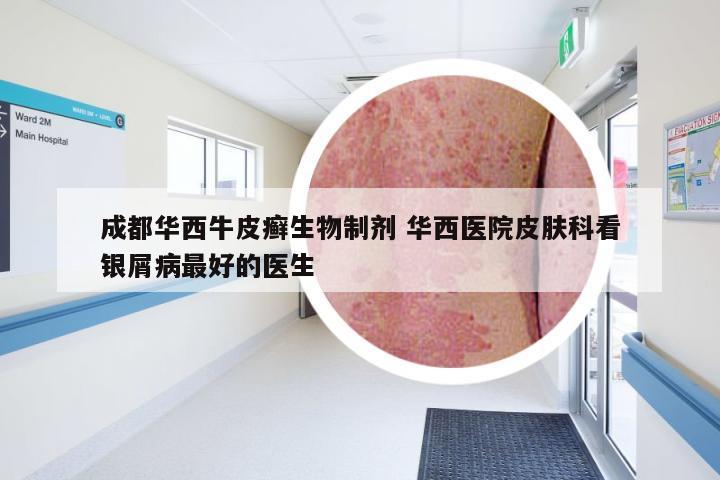 成都华西牛皮癣生物制剂 华西医院皮肤科看银屑病最好的医生