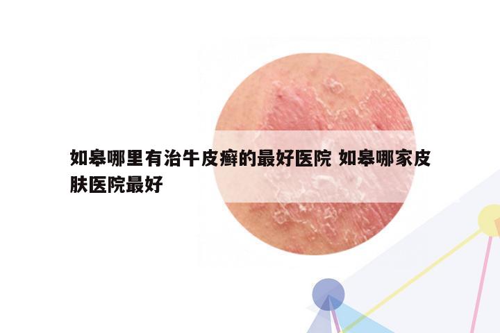 如皋哪里有治牛皮癣的最好医院 如皋哪家皮肤医院最好