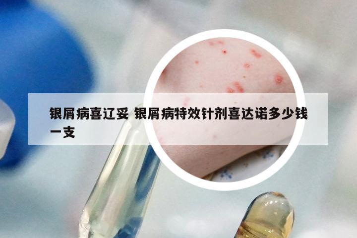 银屑病喜辽妥 银屑病特效针剂喜达诺多少钱一支