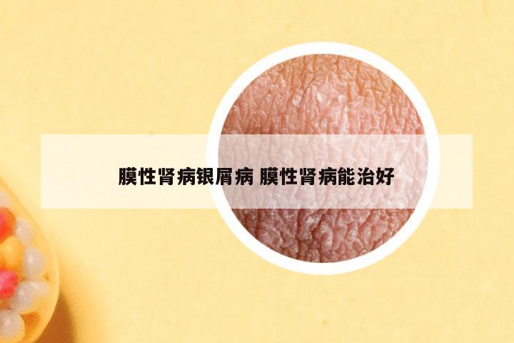 膜性肾病银屑病 膜性肾病能治好