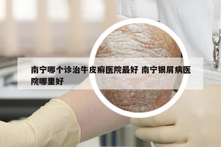 南宁哪个诊治牛皮癣医院最好 南宁银屑病医院哪里好