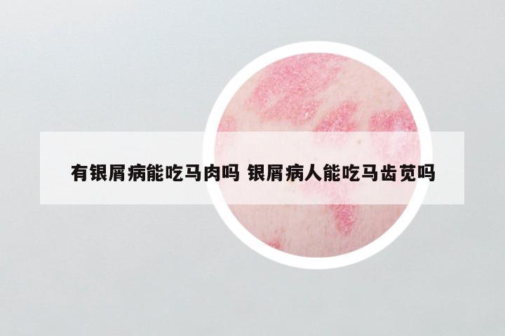 有银屑病能吃马肉吗 银屑病人能吃马齿苋吗