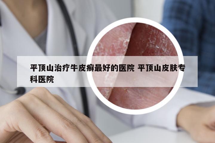 平顶山治疗牛皮癣最好的医院 平顶山皮肤专科医院