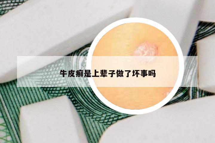 牛皮癣是上辈子做了坏事吗