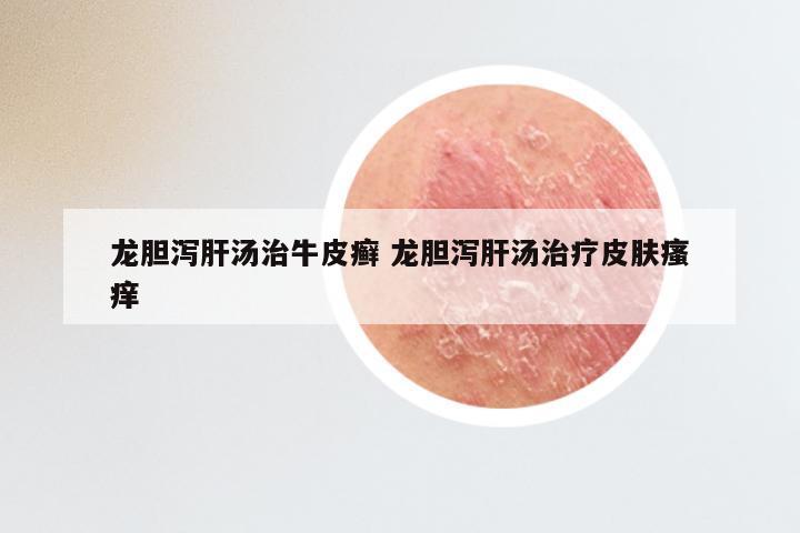 龙胆泻肝汤治牛皮癣 龙胆泻肝汤治疗皮肤瘙痒