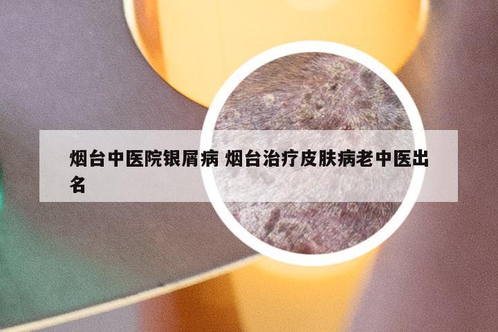 烟台中医院银屑病 烟台治疗皮肤病老中医出名