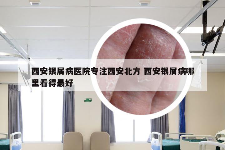 西安银屑病医院专注西安北方 西安银屑病哪里看得最好