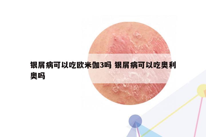 银屑病可以吃欧米伽3吗 银屑病可以吃奥利奥吗