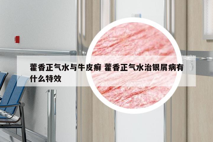 藿香正气水与牛皮癣 藿香正气水治银屑病有什么特效