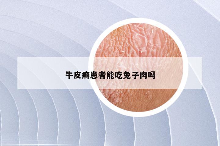 牛皮癣患者能吃兔子肉吗