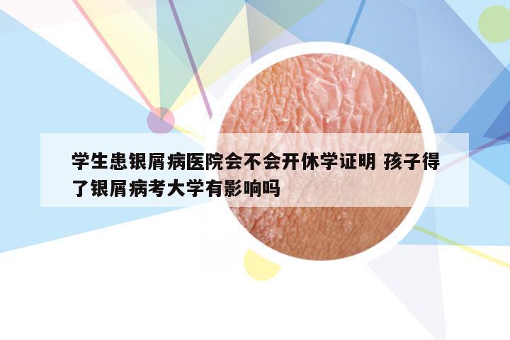 学生患银屑病医院会不会开休学证明 孩子得了银屑病考大学有影响吗