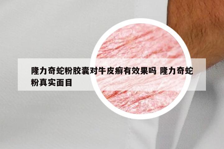 隆力奇蛇粉胶囊对牛皮癣有效果吗 隆力奇蛇粉真实面目
