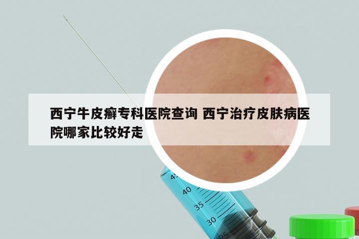西宁牛皮癣专科医院查询 西宁治疗皮肤病医院哪家比较好走
