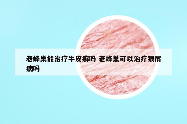 老蜂巢能治疗牛皮癣吗 老蜂巢可以治疗银屑病吗
