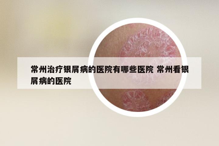 常州治疗银屑病的医院有哪些医院 常州看银屑病的医院