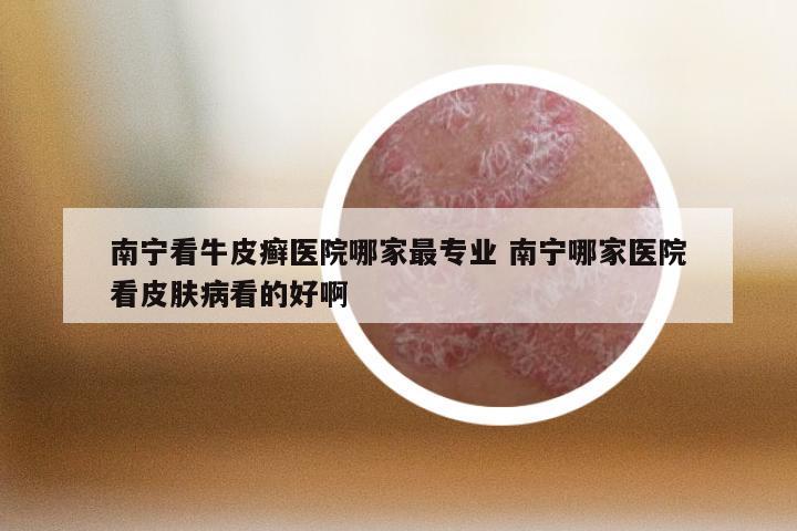 南宁看牛皮癣医院哪家最专业 南宁哪家医院看皮肤病看的好啊