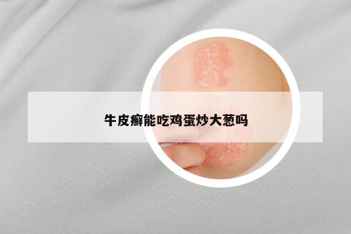 牛皮癣能吃鸡蛋炒大葱吗