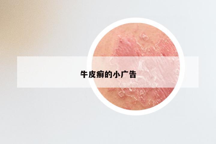 牛皮癣的小广告