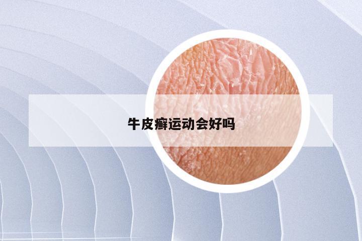 牛皮癣运动会好吗