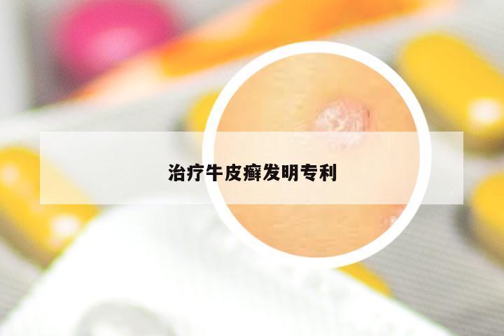 治疗牛皮癣发明专利