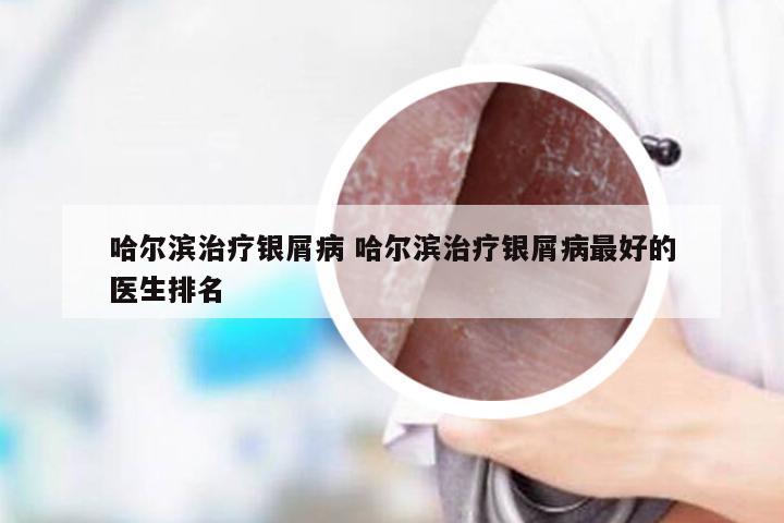 哈尔滨治疗银屑病 哈尔滨治疗银屑病最好的医生排名