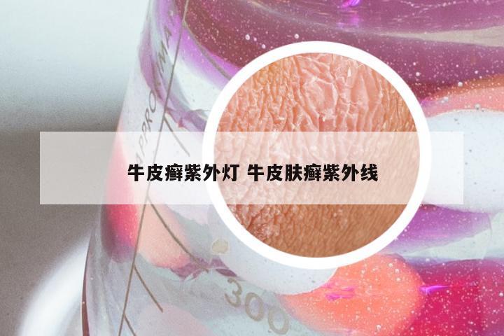 牛皮癣紫外灯 牛皮肤癣紫外线