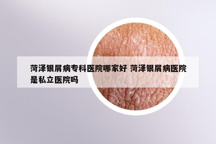 菏泽银屑病专科医院哪家好 菏泽银屑病医院是私立医院吗