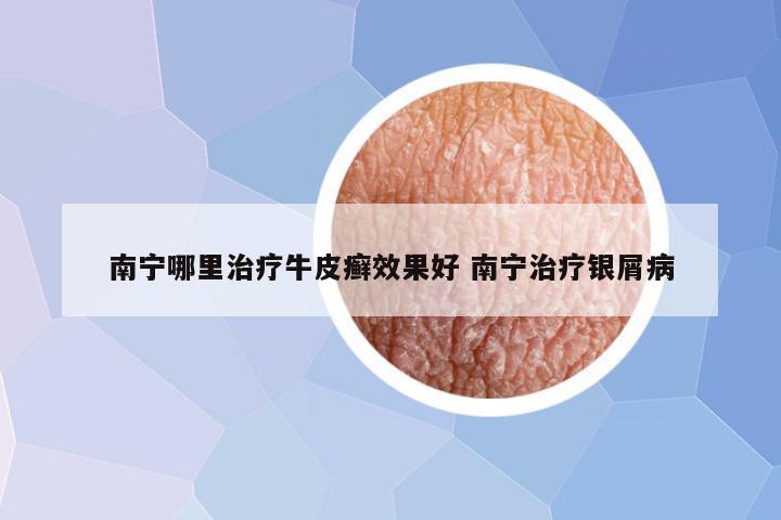南宁哪里治疗牛皮癣效果好 南宁治疗银屑病