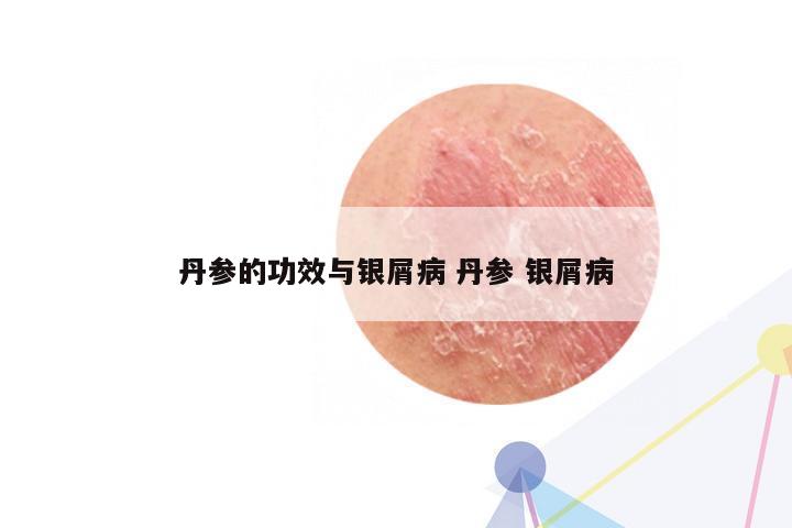 丹参的功效与银屑病 丹参 银屑病