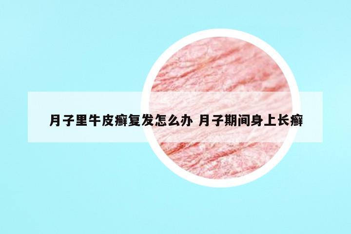 月子里牛皮癣复发怎么办 月子期间身上长癣