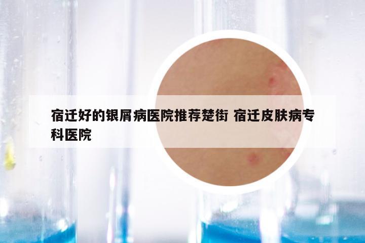 宿迁好的银屑病医院推荐楚街 宿迁皮肤病专科医院