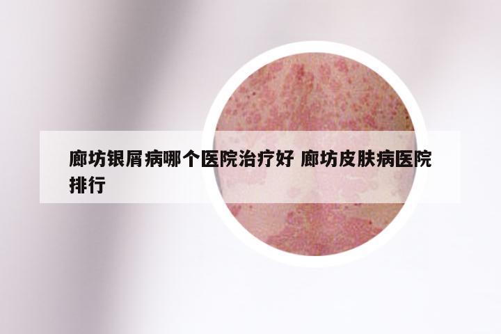 廊坊银屑病哪个医院治疗好 廊坊皮肤病医院排行