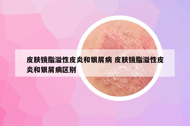 皮肤镜脂溢性皮炎和银屑病 皮肤镜脂溢性皮炎和银屑病区别