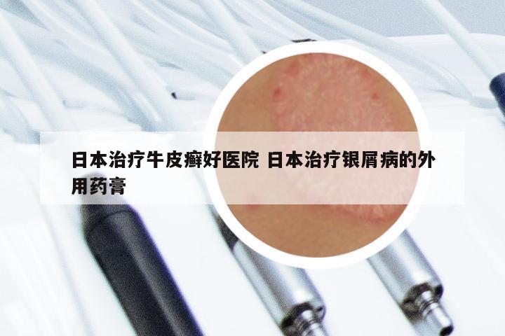 日本治疗牛皮癣好医院 日本治疗银屑病的外用药膏