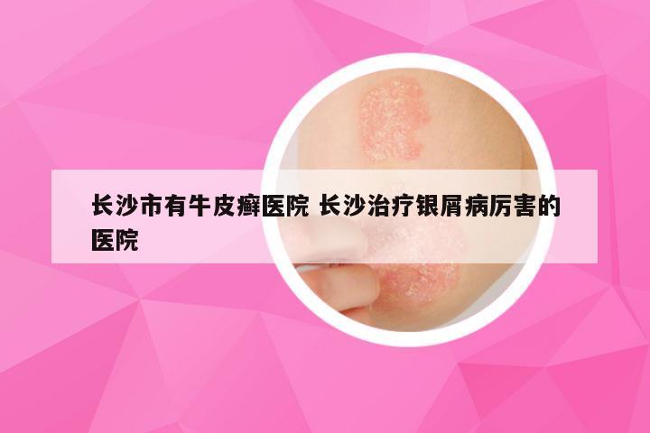 长沙市有牛皮癣医院 长沙治疗银屑病厉害的医院