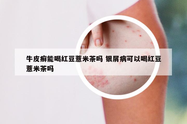 牛皮癣能喝红豆薏米茶吗 银屑病可以喝红豆薏米茶吗