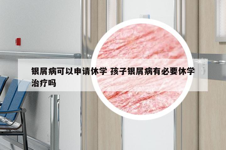银屑病可以申请休学 孩子银屑病有必要休学治疗吗