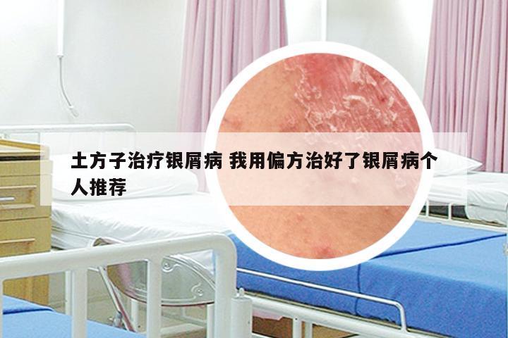 土方子治疗银屑病 我用偏方治好了银屑病个人推荐