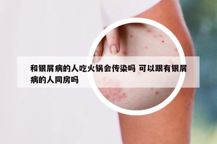 和银屑病的人吃火锅会传染吗 可以跟有银屑病的人同房吗