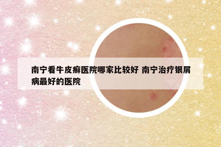 南宁看牛皮癣医院哪家比较好 南宁治疗银屑病最好的医院