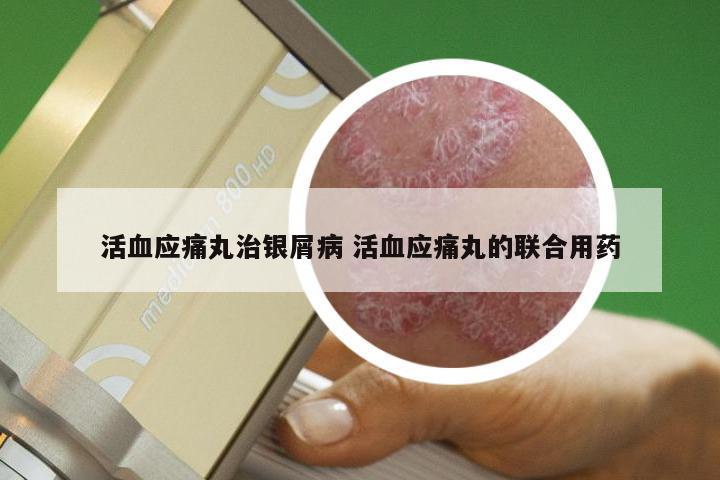 活血应痛丸治银屑病 活血应痛丸的联合用药